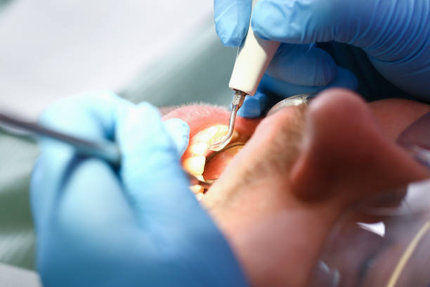 Best Emergency Treatment for Dental Infections or Abscesses in Captains Cove, VA