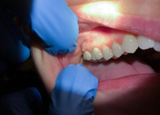 Best Urgent Care for Lost Fillings or Crowns in Captains Cove, VA