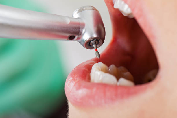 Best Emergency Root Canal Treatment in Captains Cove, VA